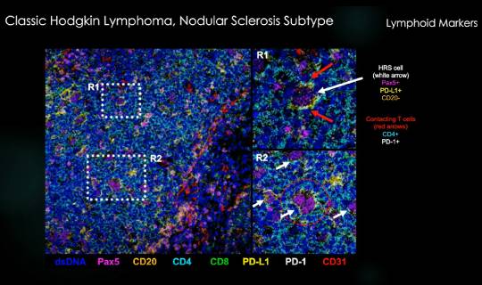 MIBI spatial proteomic analysis of Hodgkin Lymphoma