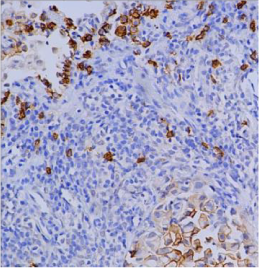 CD138-IHC-staining-FFPE-human-lung-adenocarcinoma