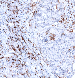 CD206-IHC-staining-FFPE-human-p16+squamous-cell-carcinoma