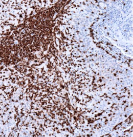 MPO-IHC-staining-FFPE-human-lung-squamous-cell-carcinoma