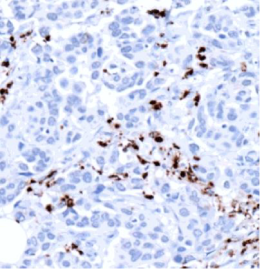 MPO-IHC-staining-FFPE-human-urothelial-carcinoma