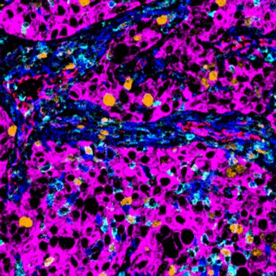 MIBI image of tumor tissue