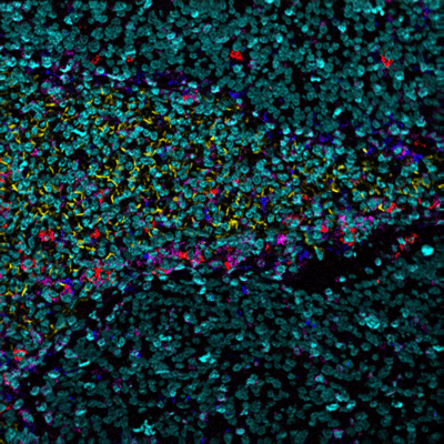 high resolution MIBI image of tumor tissue