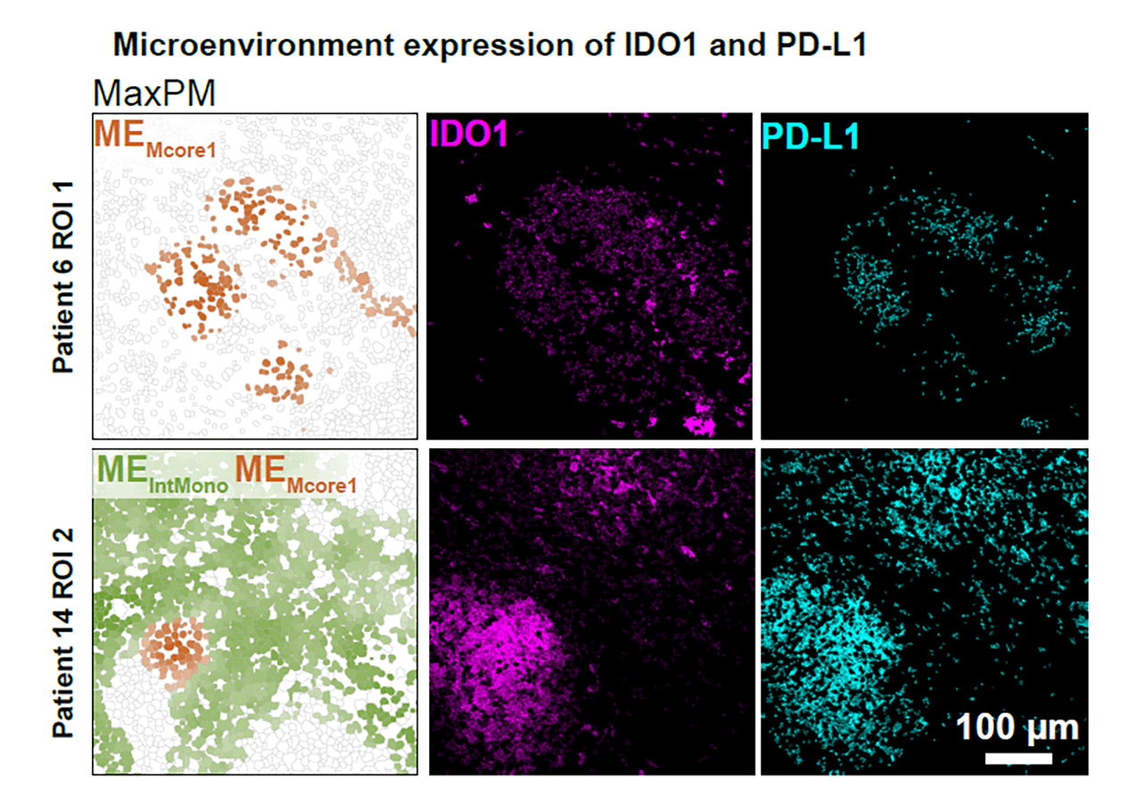 MIBI Blog - PD-L1 and IDO1 expression in two tuberculosis granuloma patients