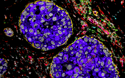 Spatial Proteomics Sheds Light on Breast Cancer Progression, Gives Hope for Prognostic Test
