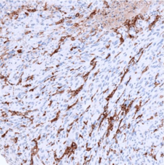 CD14-IHC-staining-FFPE-human-melanoma