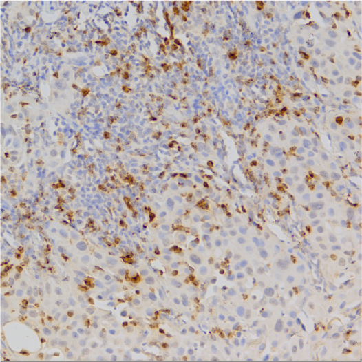 GranzymeB-IHC-staining-FFPE-human-lung-adenocarcinoma