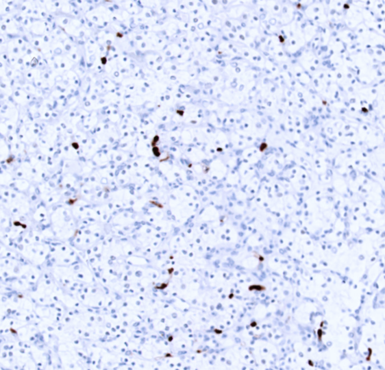 HIF-1a-IHC-staining-FFPE-human-clear-cell-RCC