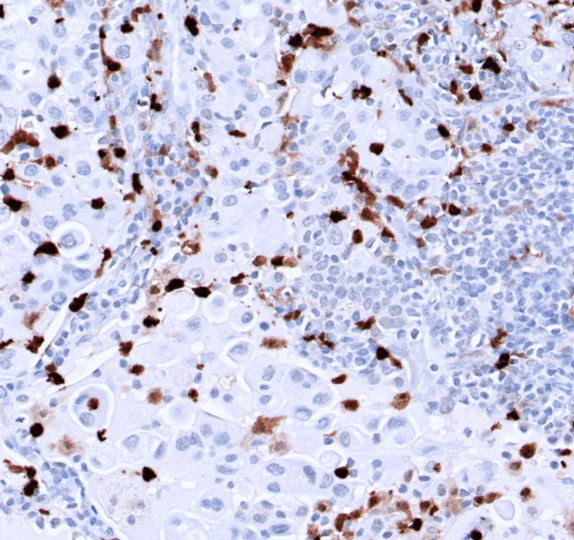 HIF-1a-IHC-staining-FFPE-human-lung-adenocarcinoma