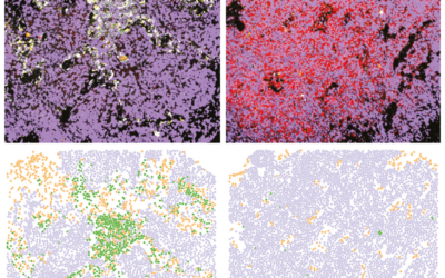 New Cancer Atlas Illuminates Small Cell Lung Cancer’s Spread with MIBI Technology