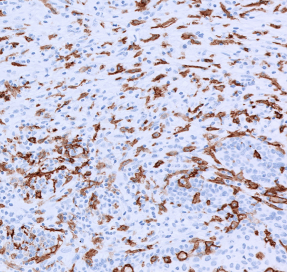 CD16-IHC-staining-FFPE-human-tongue-SCC