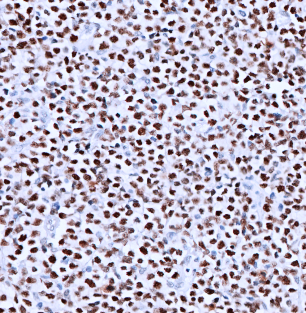 Helios-IHC-staining-FFPE-human-T-cell-lymphoma