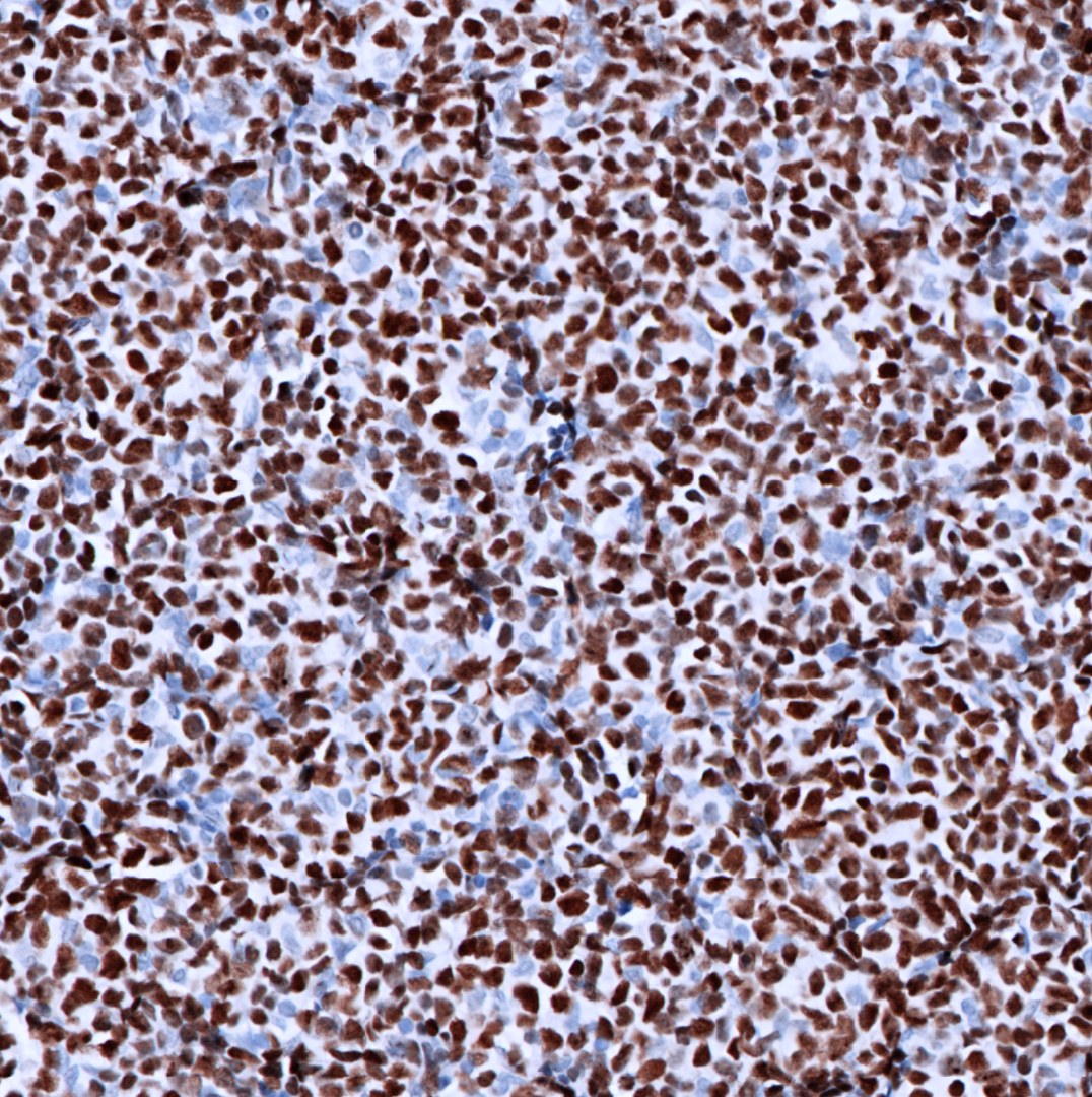 Helios-IHC-staining-FFPE-human-highgrade-B-cell-lymphoma
