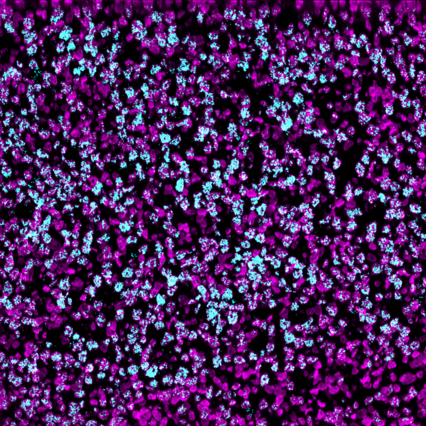 Helios-Ionpath-MIBI-staining-FFPE-human-highgrade-B-cell-lymphoma