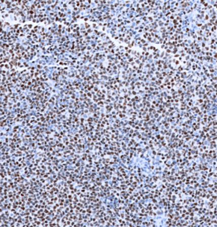 GATA3-IHC-staining-FFPE-human-T-cell-lymphoma