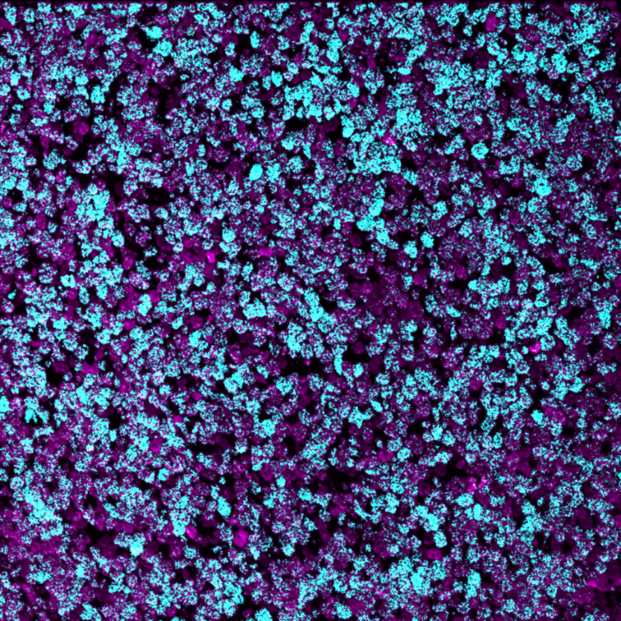GATA3-Ionpath-MIBI-staining-FFPE-human-T-cell-lymphoma