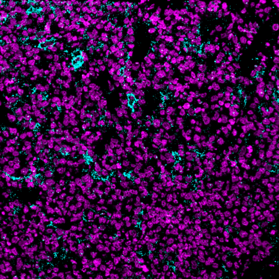 PDL1-Ionpath-MIBI-staining-FFPE-human-diffuse-large-B-cell-lymphoma