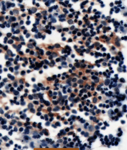 PDL1-IHC-staining-FFPE-human-diffuse-large-B-cell-lymphoma
